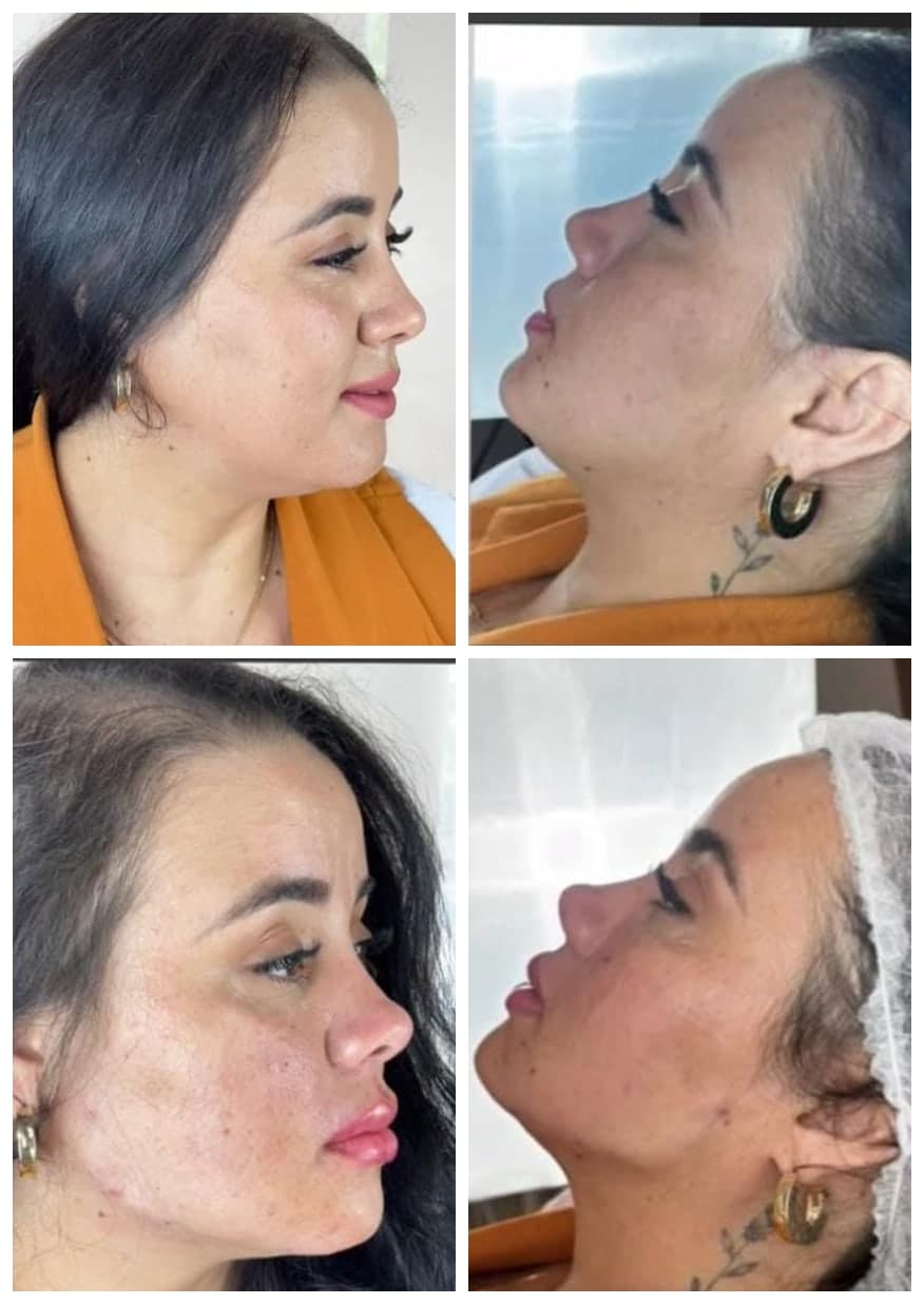 Montagem com quatro fotos de perfil da mesma paciente, antes e depois da harmonização facial